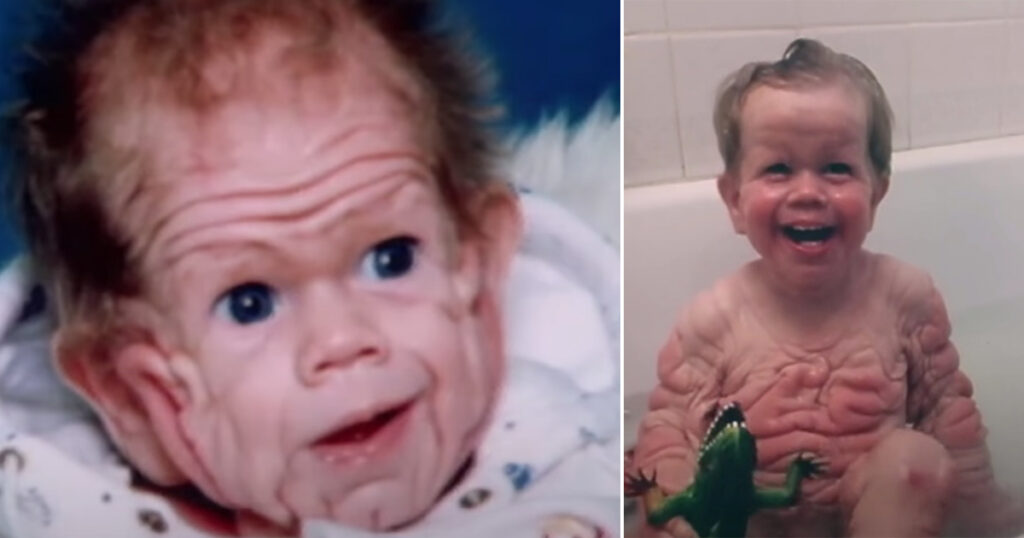 Baby with the Skin of a 5-Year-Old: Tomm Tennent's Incredible Story at 28