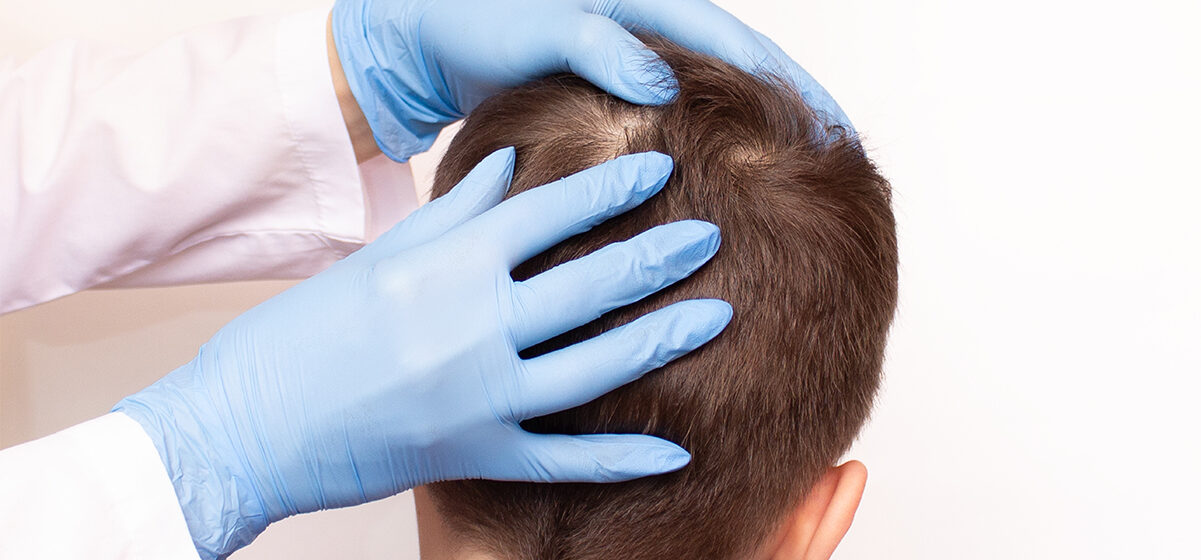 Head Lice Nightmare Goes Viral: A Man’s Extreme Battle