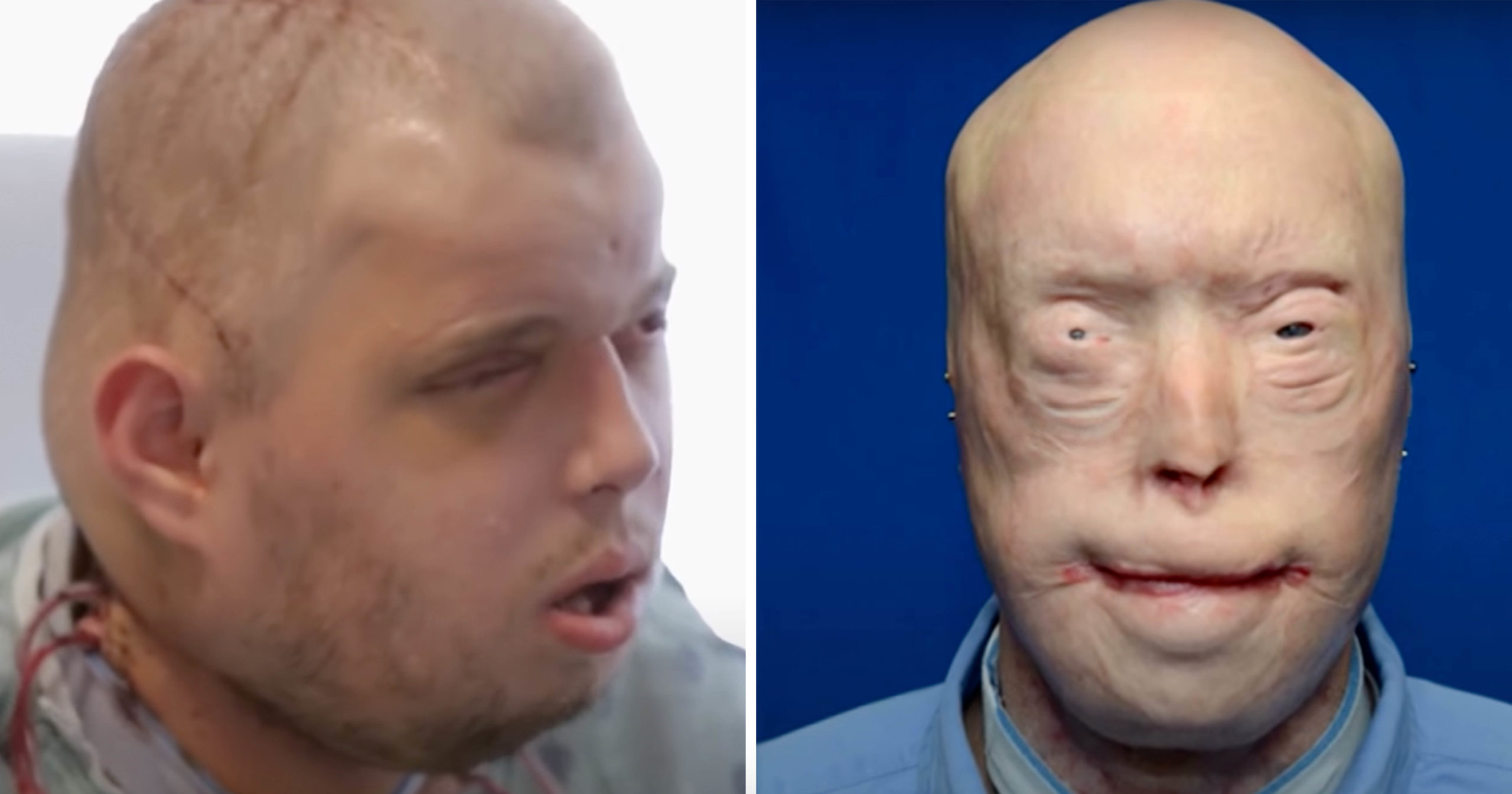 From Burn Victim to Brand New: The Incredible Transformation of a Firefighter – 7 Years Later