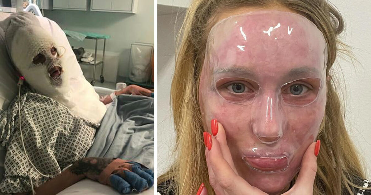 The Cruel Prank That Melted Her Face – A Year Later, The Young Woman is Unrecognizable