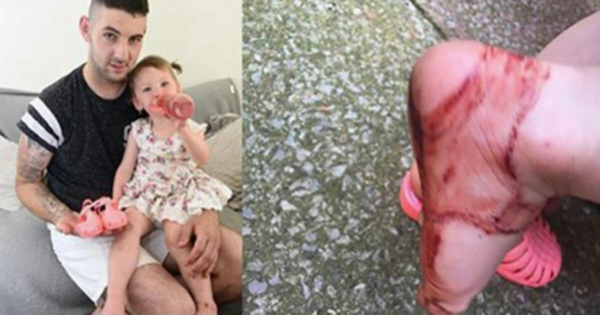 Beware of sandalen: Mother warns after two-year-old’s feet are cut open