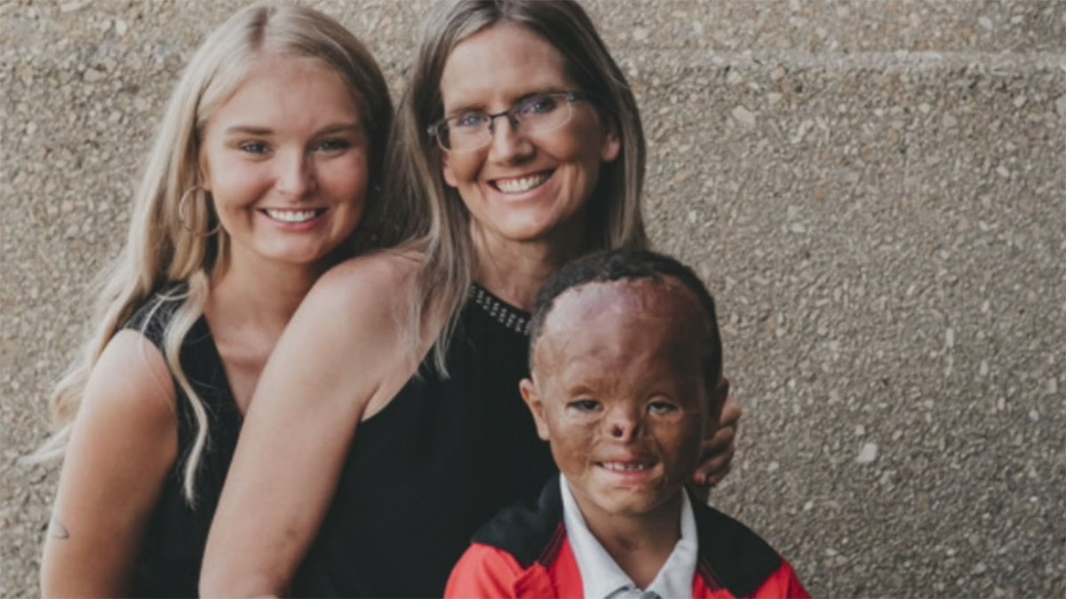 From Adoption to Redemption: The Inspiring Journey of a Boy with Burns