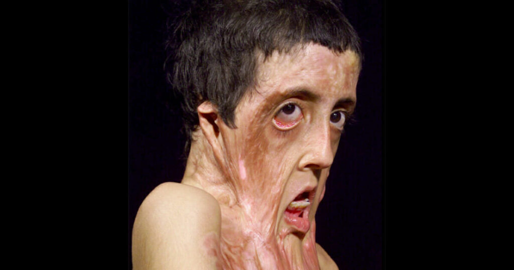 Girl's Face Melts Away: A Year Later, She Shocks Doctors with Dramatic Transformation
