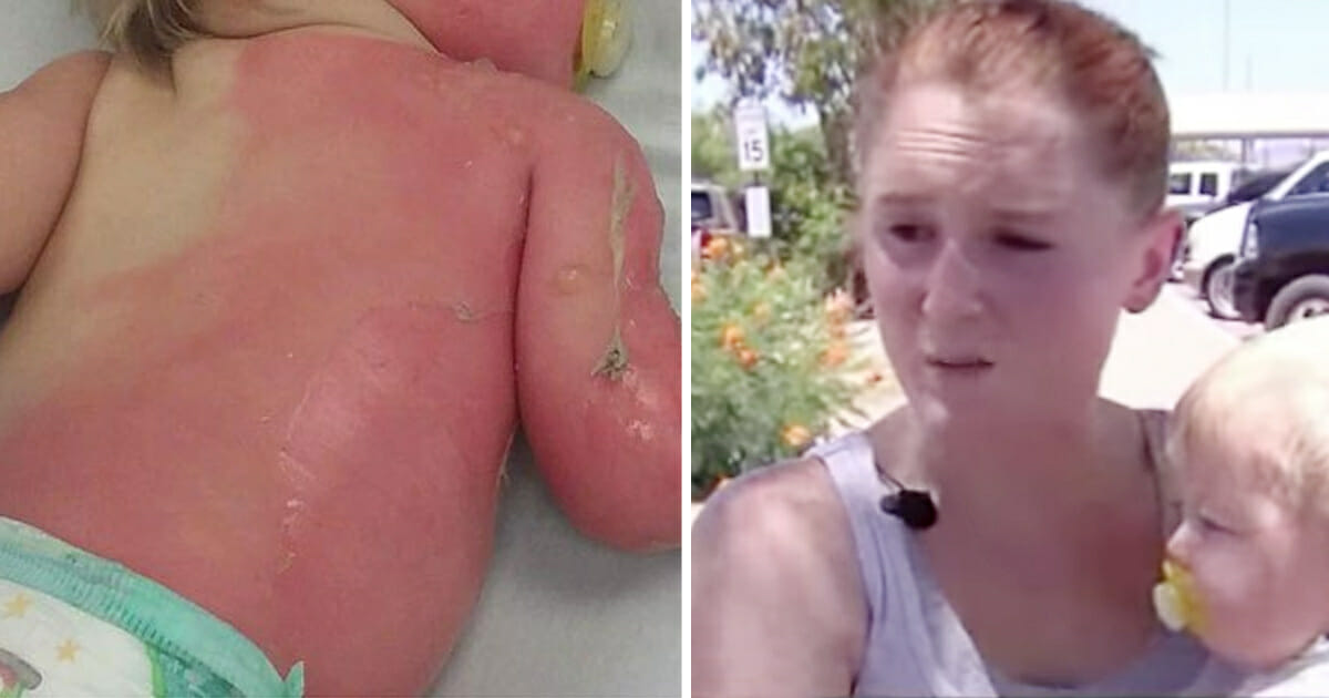 Mom’s Warning: Boy Burned by Hot Water in Garden Hose