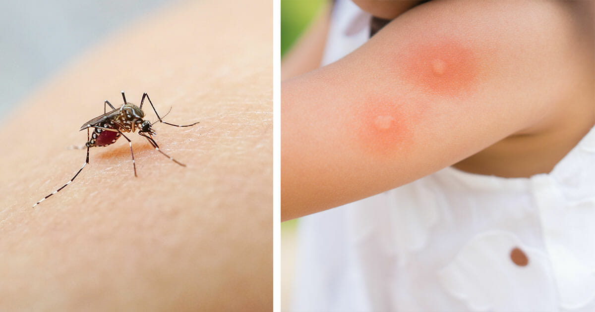 Soothe Mosquito Bites with This Top Lifehack: Use a Cold Tea Bag!