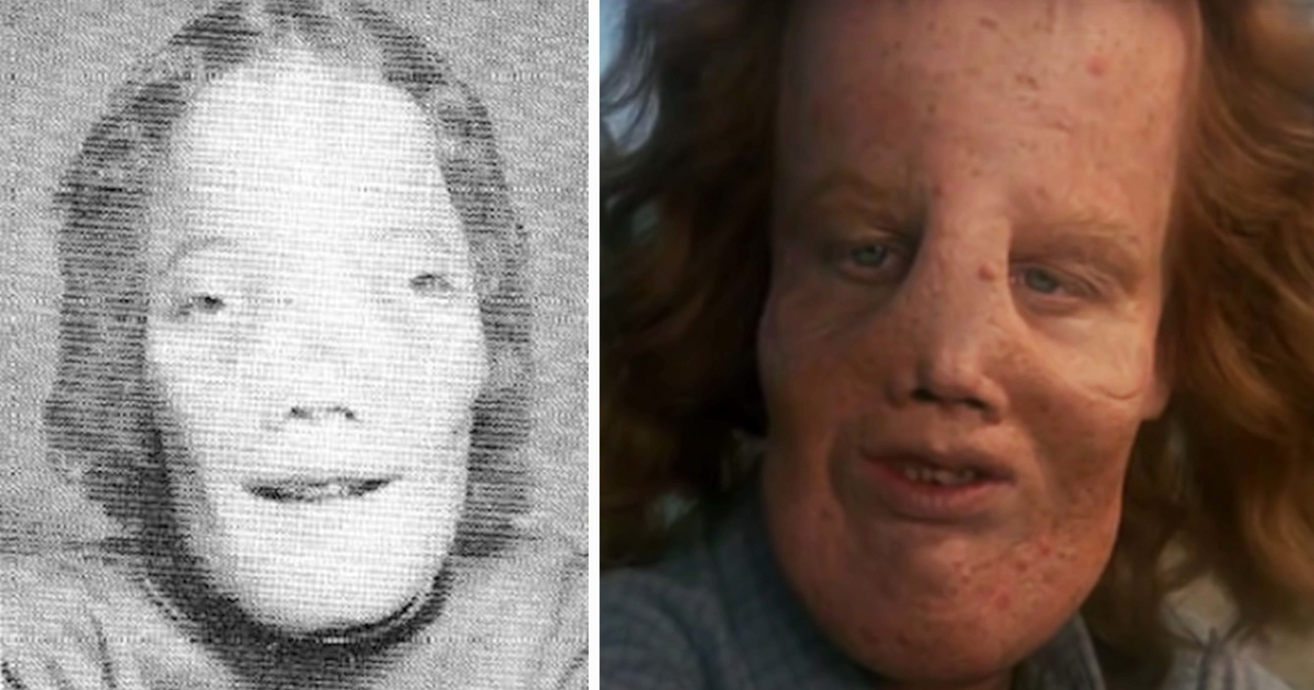 The Real Rocky Dennis: Inspiring the Film ‘Mask’