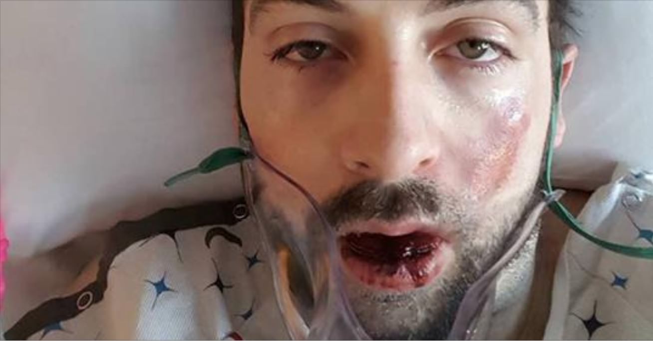 Exploding Device Shocks Father – His Warning to Others